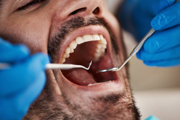Best Emergency Tooth Extraction in Talty, TX
